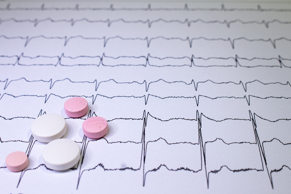 Elektrokardiogramm beim Brugada-Syndrom, bei dem Symptome wie Ohnmacht, Herzklopfen oder Herzstillstand auftreten können. (Symbolbild)
