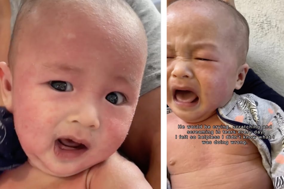 Das Baby war gegen jede Pre-Milch allergisch.