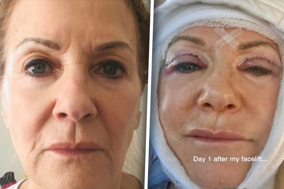 Pamela Allyn se už po šedesátých letech nepoznala, ve svých sedmdesáti podstoupila facelift.