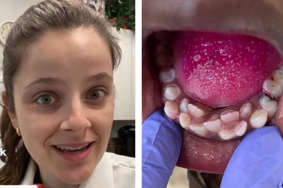 Die Zahnärztin Dr. Ashley Brede Ciapciak präsentiert in ihrem TikTok-Video die große Fülle an Zähnen im Mund eines jungen Mädchens.