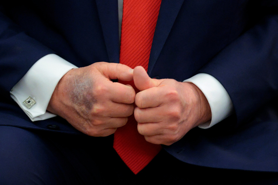 President Trump has been seen regularly with visible bruising on his right hand, which he sometimes covers with makeup.