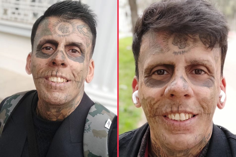 Regretful tattoo addict reveals staggering ink removal transformation