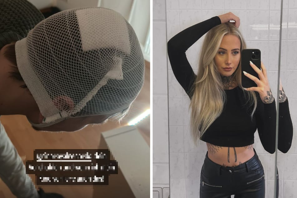 Auf ihrem Instagram-Kanal zeigt Emely Siebert (24) die Kopfverletzung ihres Freundes.