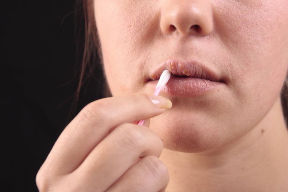 HSV-1 verursacht häufig Lippenherpes. Ob die Infektion der US-Amerikanerin auf den Vorfall in der Fast-Food-Filiale zurückzuführen ist, wird noch untersucht. (Symbolfoto)