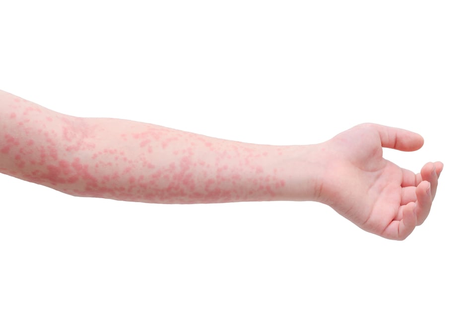 Masern führen zu Hautausschlag und erkältungsähnlichen Beschwerden. Die Virusinfektion ist hochansteckend.