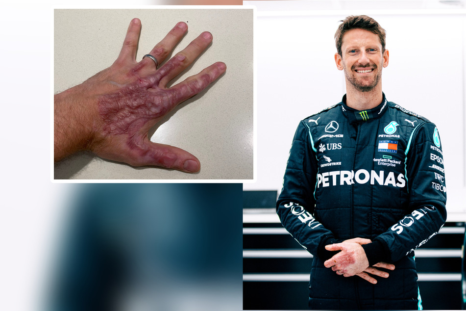 Nach Horror-Unfall bei Formel 1: Neue Haut für Grosjeans Hand!