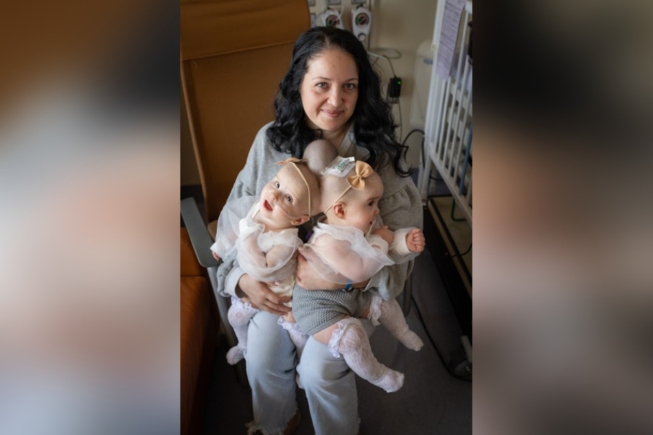 Mutter Liliya zeigt ihre beiden am Kopf zusammen gewachsenen Kinder Micaela and Abigail zwei Tage vor der Operation.