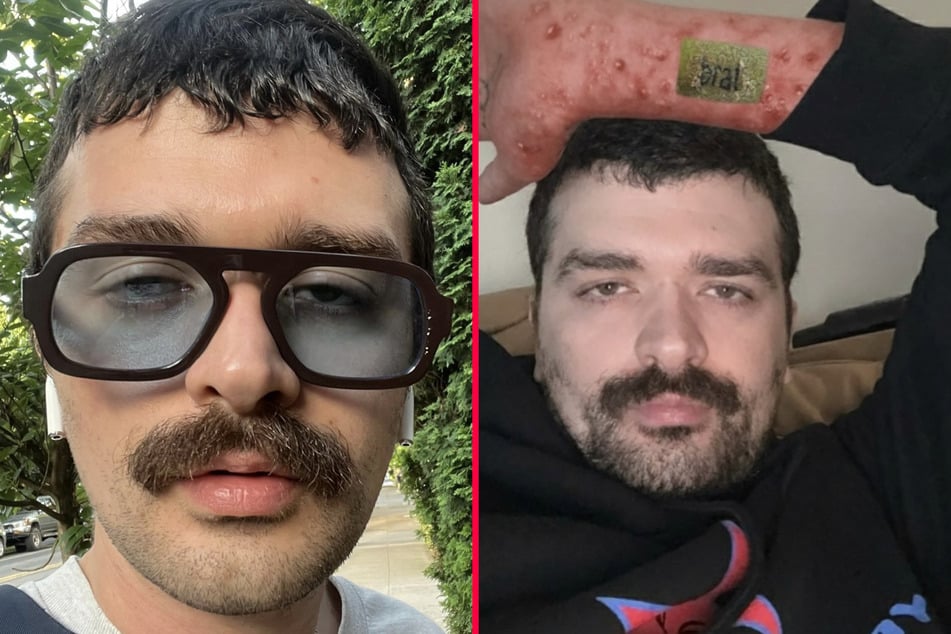 Xiu went instantly viral when he shared the horrific infection he got from a Charli XCX Brat tattoo on his arm.