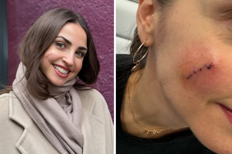 Auf Instagram präsentiert Ekaterina Leonova (38) die Fortschritte des Heilungsprozesses nach ihrer Muttermal-Operation im Dezember.