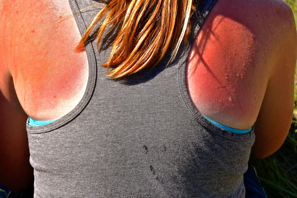 Wegen der hohen UV-Strahlung droht ungeschützter Haut schnell Sonnenbrand. (Symbolbild)