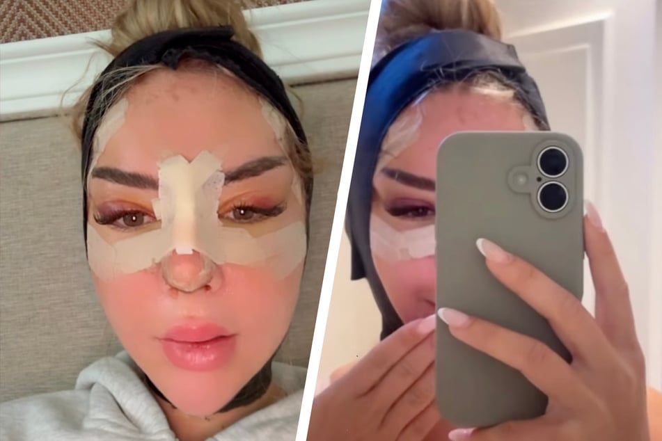 Emma Fernlund (24) zeigt sich schon ein paar Tage nach ihren Schönheitsoperationen auf Instagram.