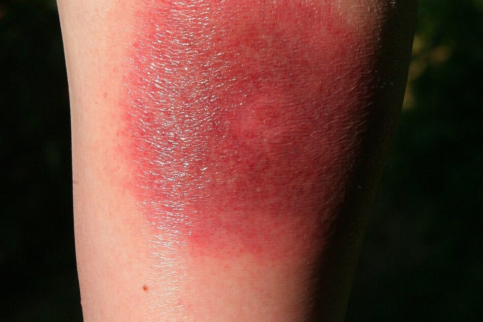 Eine Wade nach einem Zeckenstich: Eines der charakteristischen Symptome einer Borreliose ist das sogenannte Erythema migrans, auch Wanderröte genannt.