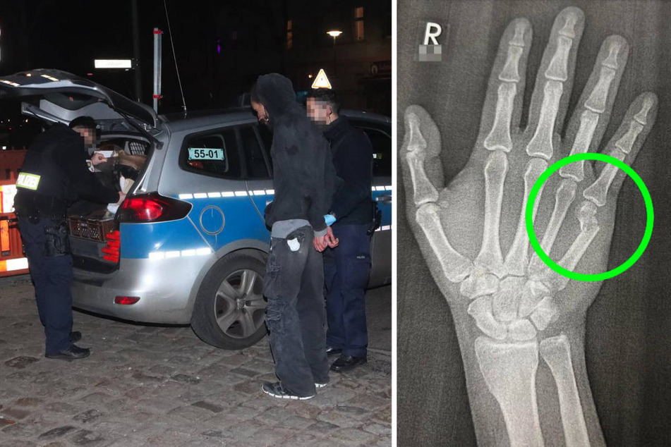 Der Tatverdächtige hat sich gegen seine Festnahme gewehrt und einem Polizisten die Hand gebrochen, wie das Röntgenbild auf der rechten Seite zeigt.