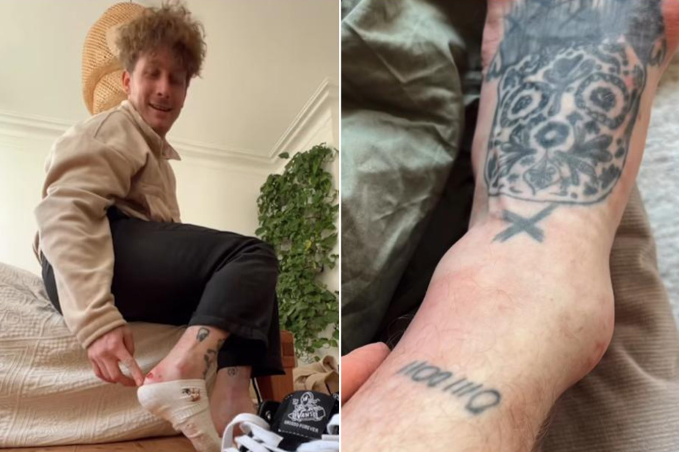 Anti-Influencer Malte Zierden (30) hat sich - mal wieder - verletzt. Dieses Mal passierte das Unglück beim Skaten.