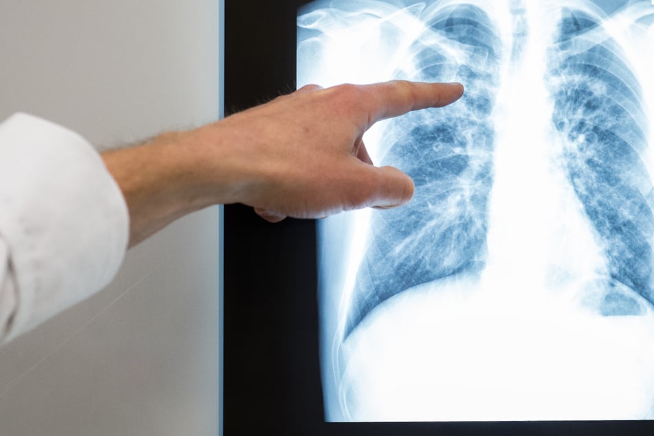 Über 100 Kontaktpersonen: Schon wieder Tuberkulose-Fall in Sachsen