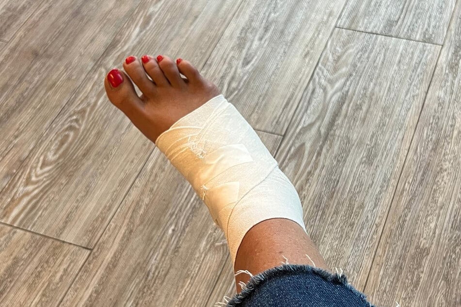 Vanessa Blumhagen (45) präsentiert ihren verletzten Fuß.
