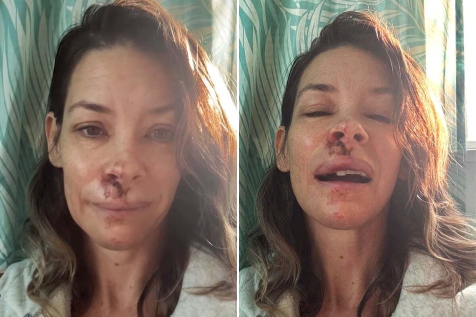 Marvel star Evangeline Lilly reveals shocking brain damage after fall
