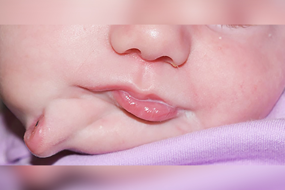 Ein Baby (hier fünf Wochen alt) besaß drei Lippen. Hier ist kein Photoshop im Spiel, Ärzte wurden wirklich mit diesem Fall konfrontiert.