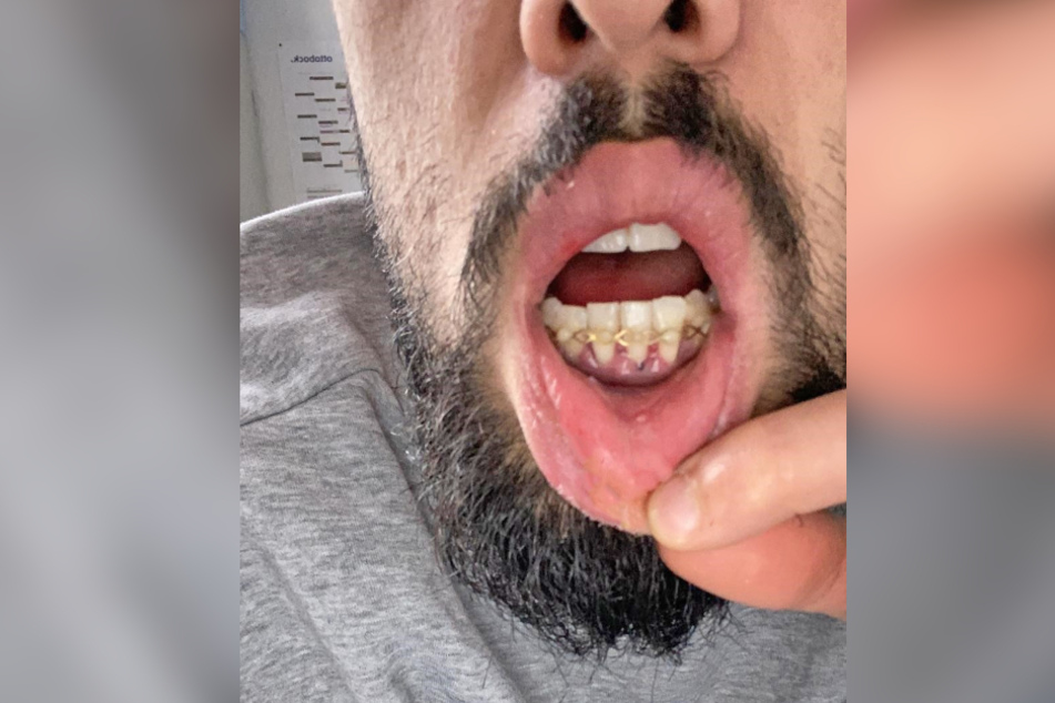 Stomatologie-Selfie: Isa Dogan zeigt seine gerichteten und mit Drähten fixierten Zähne.