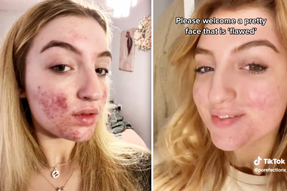 Teenagerin von TikTok gesperrt! Akne-Videos sind "grausamer Inhalt!