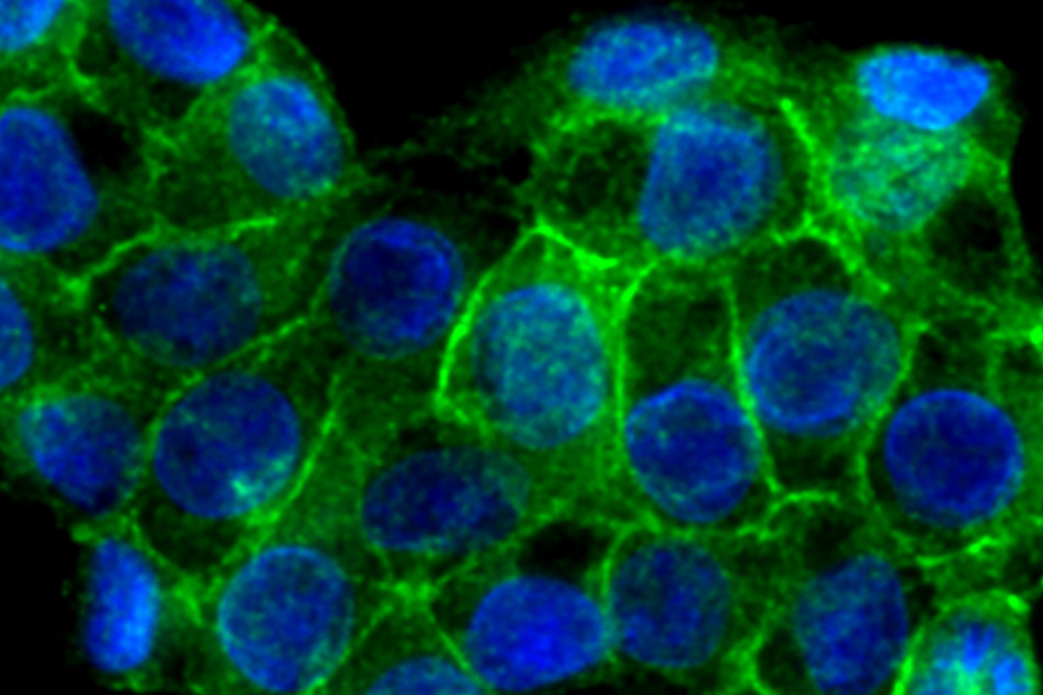 Zellen mit ausgeschaltetem MLLT6-Gen bildeten deutlich weniger PD-L1-Protein (grün), das wichtige Immunzellen ausbremst wie in dieser Darmkrebszelle.