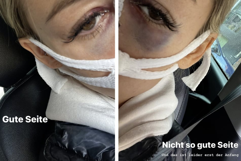 Samantha Abdul (32) präsentiert ihr Gesicht nach ihrem zweiten Nose-Job.