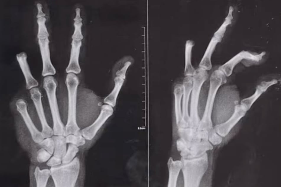 X-rays show the mutilated hand.