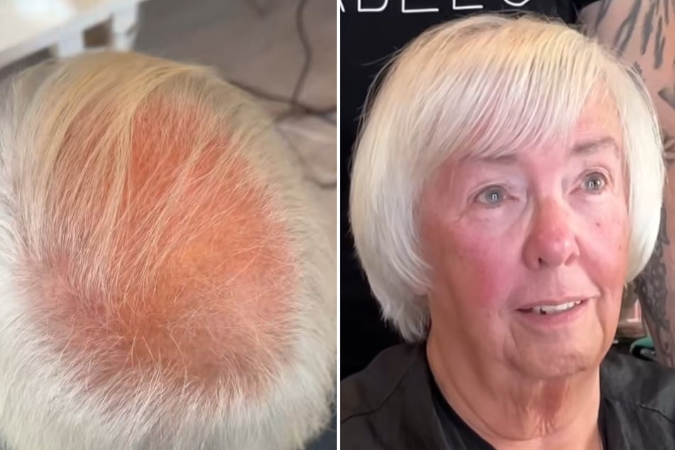 Liz leidet seit rund 15 Jahren unter Haarausfall.