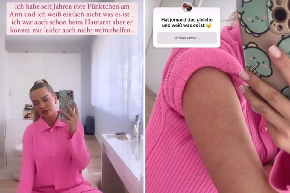 In ihrer Instagram-Story zeigte Laura Maria Rypa (27) ihren Fans das Hautproblem.