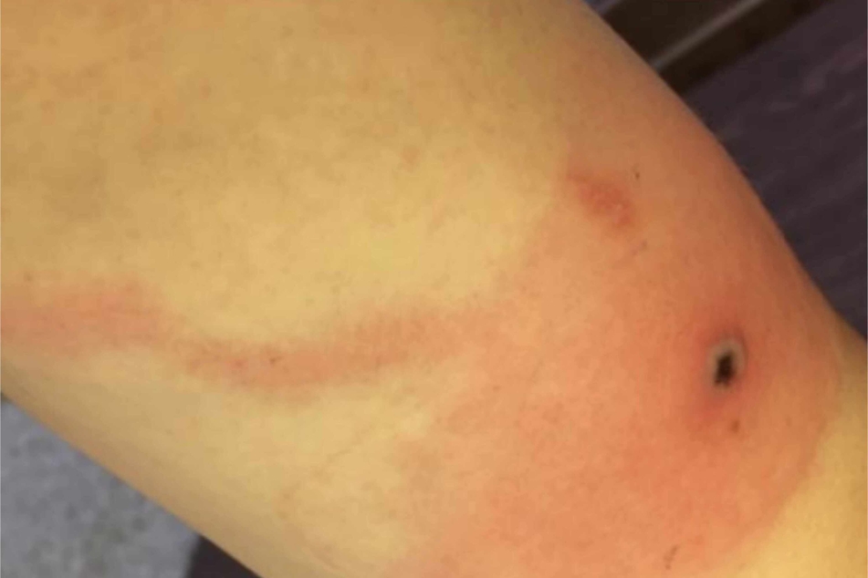 Alaska Division of Public Health provided example photos of an Alaskapox skin lesion, about 10 days after symptom onset.