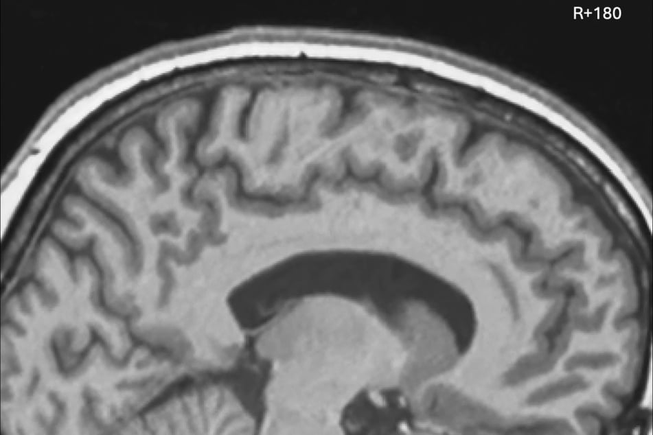 Los meses en el espacio cambian a las personas: los astronautas de larga duración muestran desplazamientos cerebrales notables.