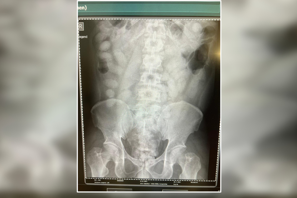 Das Röntgenbild des Körperschmugglers zeigt, dass sein Magen-Darm-Trakt mit vielen Drogenpäckchen gefüllt war.