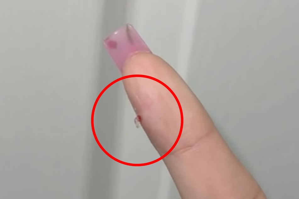 Tříska se z tohoto malého otvoru v prstu vynořila po třech a půl letech.