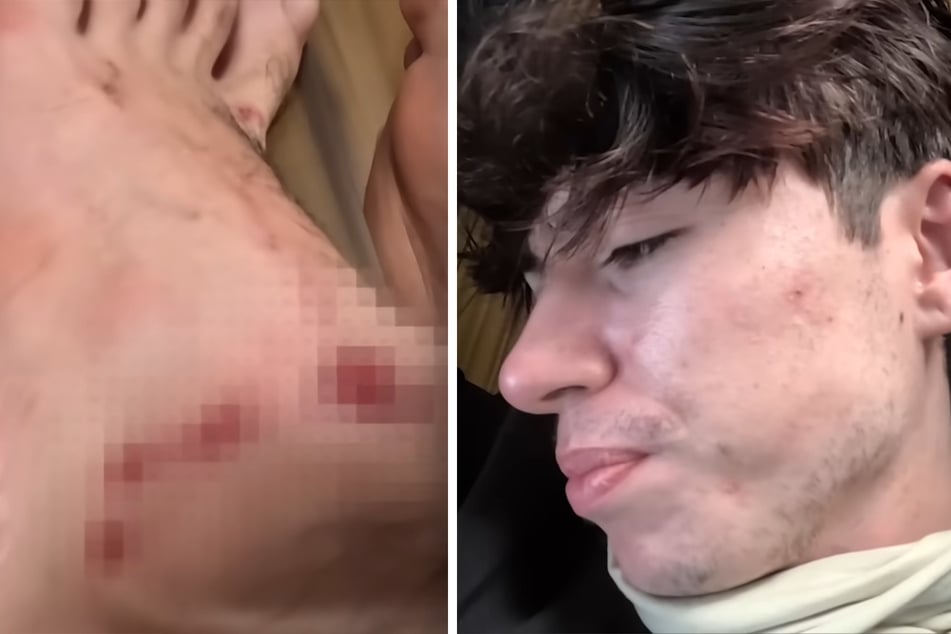 Influencer Kris Grippo (23) hat schmerzhafte Wunden an den Füßen.