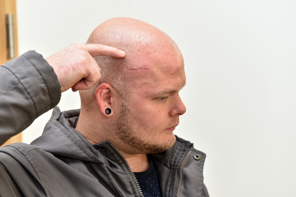 Die lange Narbe am Kopf wird Michel S. (29) nie wieder los. Noch immer ist der Postbote krankgeschrieben, laboriert an lädierten Knochen, die er bei dem Unfall erlitt.