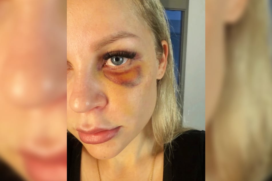 Ein Selfie mit blauem Auge - mit diesem Bild beginnt die Foto-Sammlung, in der Michelle Schellhaas (30) Verletzungen dokumentiert, die ihr angetan wurden.