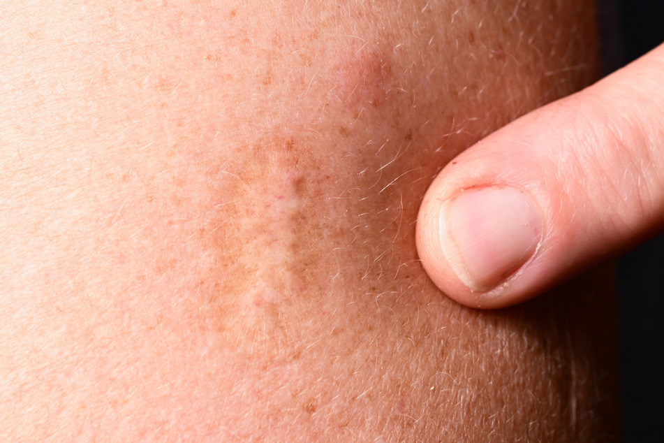Eine Narbe einer Pockenimpfung ist an einem Oberarm sichtbar. (Symbolfoto)