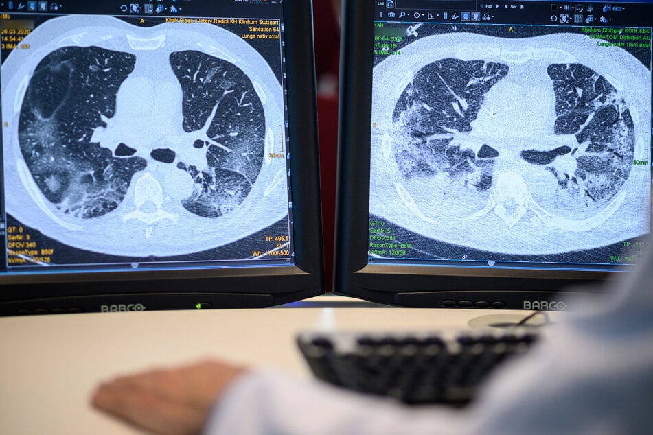Ein CT des Brustkorbs zeigte lediglich entzündliche Strukturen. (Symbolfoto)