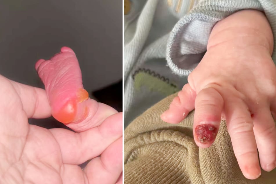 Drei Tage nach der Geburt bemerkte seine Eltern plötzlich Blasen an seinen Füßen. Wenig später stand fest: Der Junge leidet unter Epidermolysis bullosa (EB).