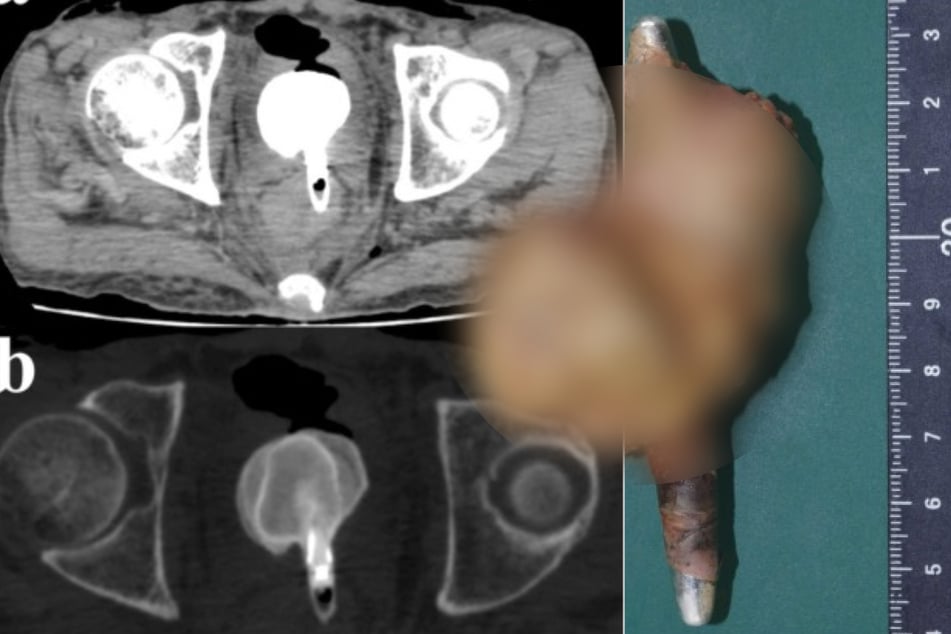 Mann findet Bruder leblos: Was man dann in seinem Körper entdeckt, macht Ärzte ratlos