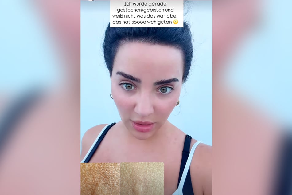 Die 29-Jährige berichtete in einer Instagram-Story von einem rätselhaften Insekten-Stich oder Spinnen-Biss. Dazu blendete sie auch Fotos der Hautschwellung ein.