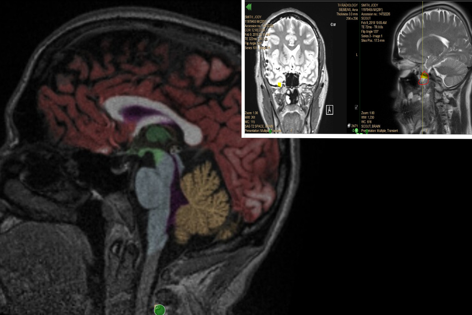 Jody Smith's pre-surgery brain scans showed the location of his seizures.