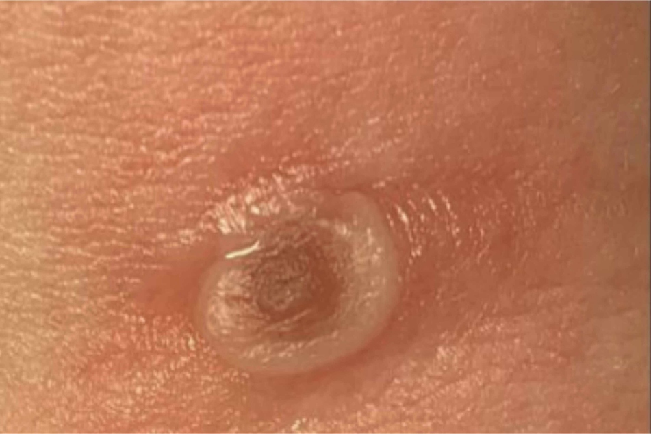 Alaska's Division of Public Health provided an example of an Alaskapox lesion about 5 days after symptom onset, shown at about 1.2 cm across.