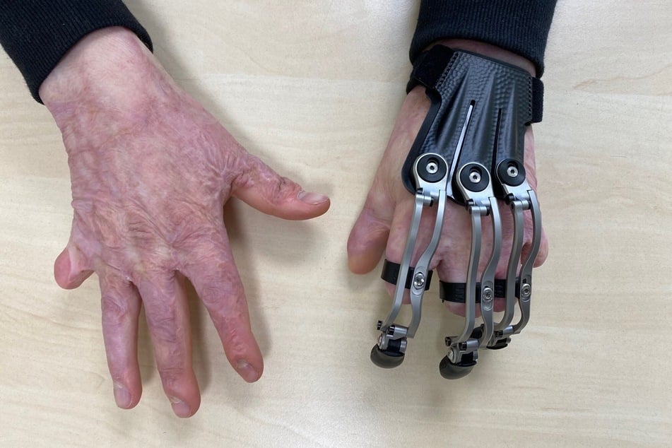 Für den 19-Jährigen wurde eine individuell angepasste Fingerprothese hergestellt.