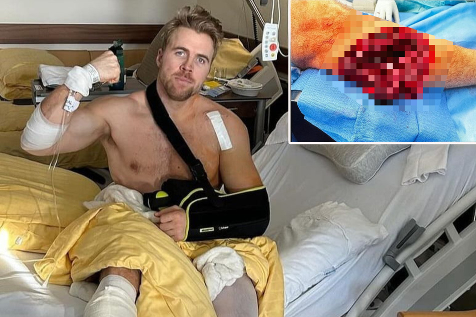 Nach Horror-Sturz: Ski-Star zeigt Schock-Bilder von seinem Bein