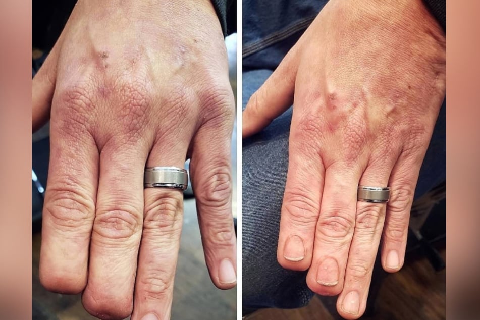 Catalano tattooed fingernails onto a man whose fingertips were sliced off by a fan belt in a construction accident.