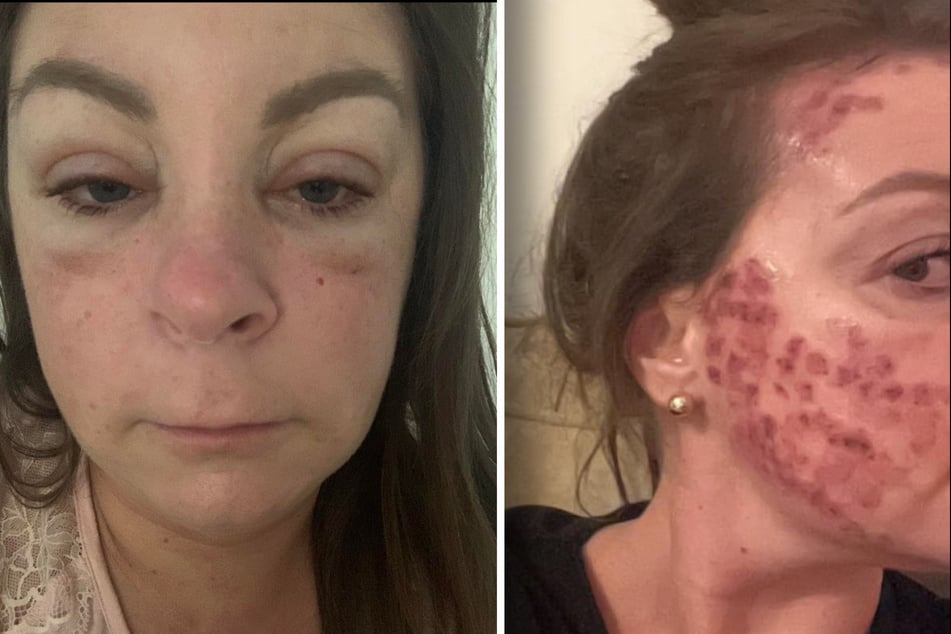 Alle acht Wochen muss sich Fionnghuala (35) einer schmerzhaften Laserbehandlung im Gesicht unterziehen.