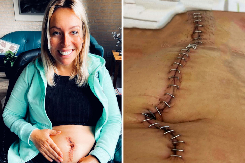 Nach ihrer Tumor-OP und der anschließenden Chemotherapie ist die 35-Jährige noch geschwächt und konnte nicht allein wieder aufstehen.