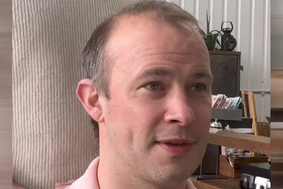 Craig Rimmer (37) kämpft schon seit seinem 18. Lebensjahr mit Haarausfall.